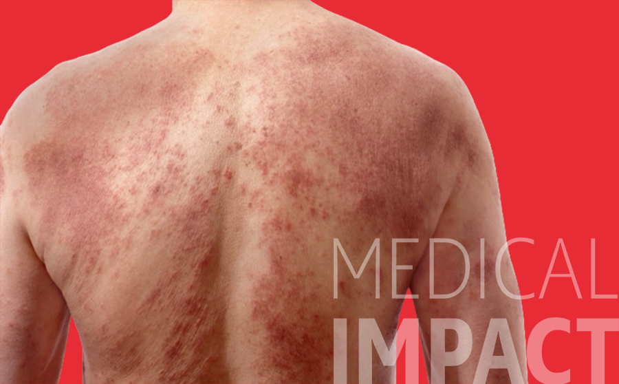 persona con Dermatitis atópica